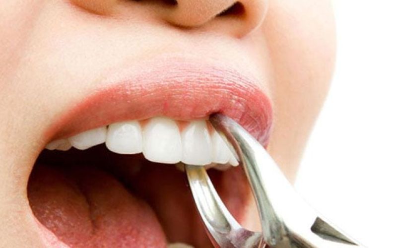 estrazione di un dente, denti da latte, viaggideldente migliori dentisti in croazia e in albania, dentisti albania, dentisti croazia