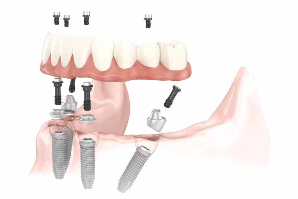 impianti-all-on-four viaggideldente
